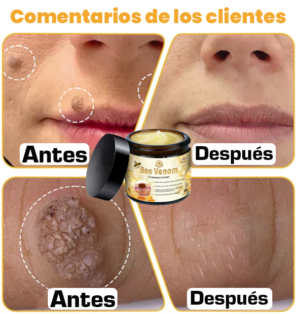 🐝 Bee Venom | Treatment Cream 🐝 (120 Gramos)